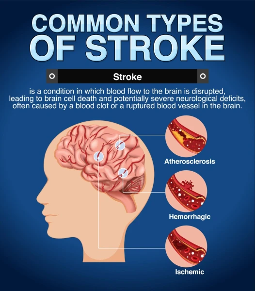 Discover stroke prevention insights from the best neurologist doctor