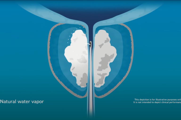 How Rezum Water Vapor Therapy Works for BPH Relief